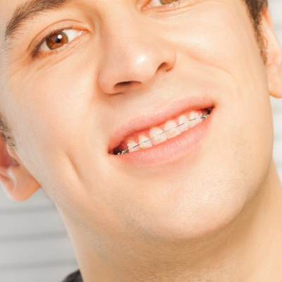 Types of Braces, Smile Straight Orthodontics