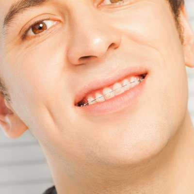 Transparent or Ceramic Braces in Wilmington - Wilmington