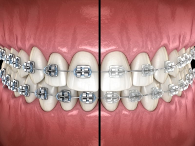 Types of Braces, Smile Straight Orthodontics