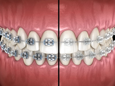 Metal vs Ceramic Braces